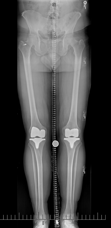 Postop legs and pelvis